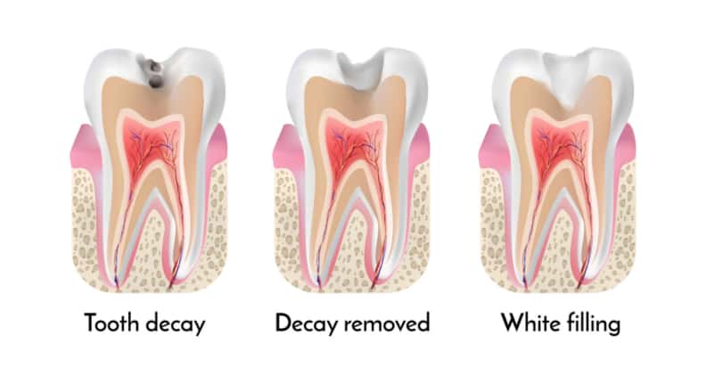 Filling Fell Out What Should I Do Pickett Family Dental