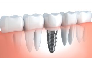 Benefits of All-On-4 Dental Implants