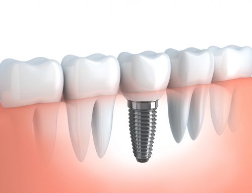 What Are the Benefits of All-On-4 Dental Implants?