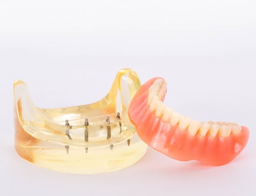 Implant-Retained Dentures