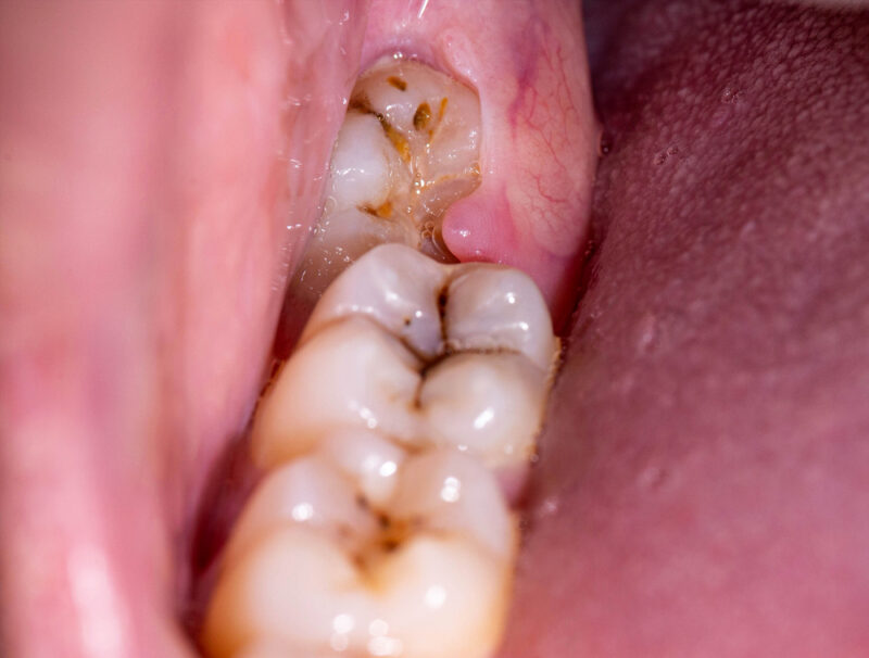 pericoronitis-causes-signs-and-treatment-pickett-family-dental