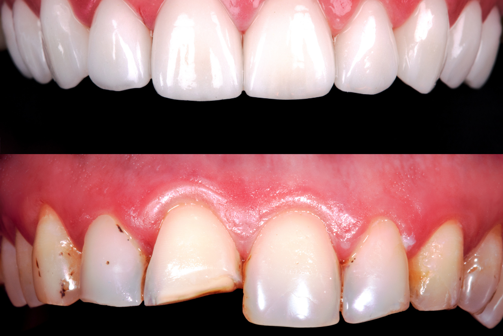 tooth reshaping
