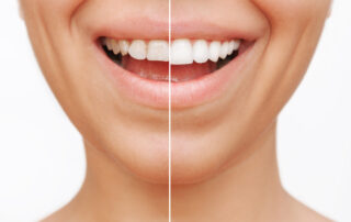 Do Veneers Ruin Your Teeth