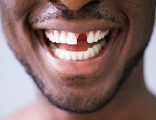 Do You Get Temporary Teeth While Waiting for Implants?