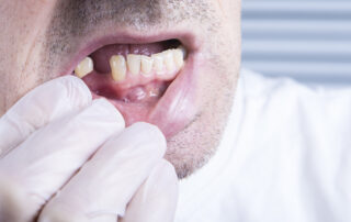 How Long Do You Without Teeth When Getting Implants