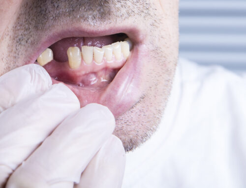 How Long Do You Go Without Teeth When Getting Implants?