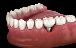 Are You a Good Candidate for Dental Implants