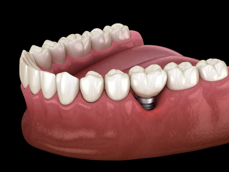 Are You a Good Candidate for Dental Implants