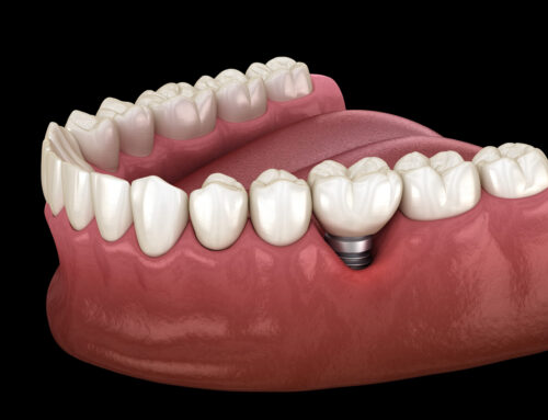 Are You a Good Candidate for Dental Implants? Here’s How to Tell